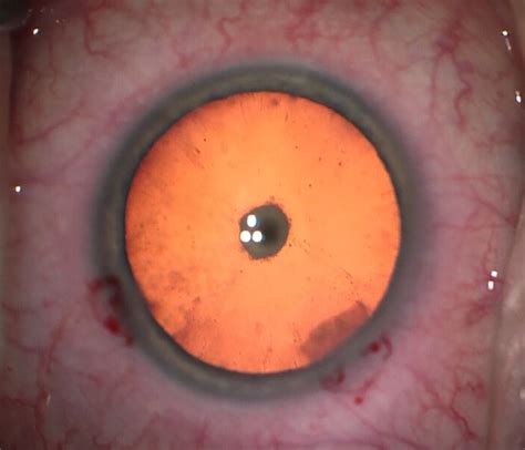 Posterior Subcapsular Cataract: Signs, Causes and Treatment