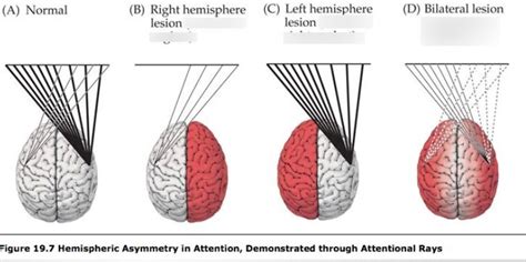 hemispheric hemineglection (visual) Diagram | Quizlet