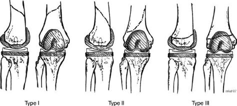 TKA Periprosthetic Fracture - Recon - Orthobullets