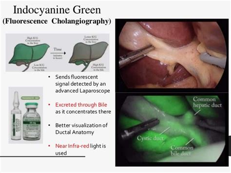 Laparoscopic Cholecystectomy Youtube