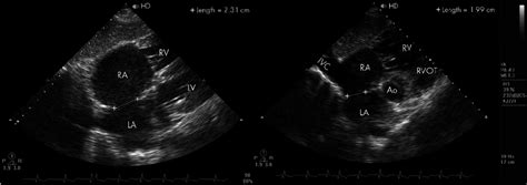 Two dimensional echocardiogram. Left panel: Subcostal four chamber ...