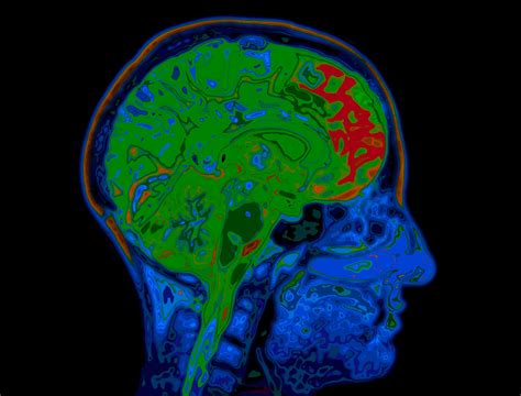 Mapping Brain Connectivity with MRI May Predict Outcomes for Cardiac Arrest Survivors, Study ...