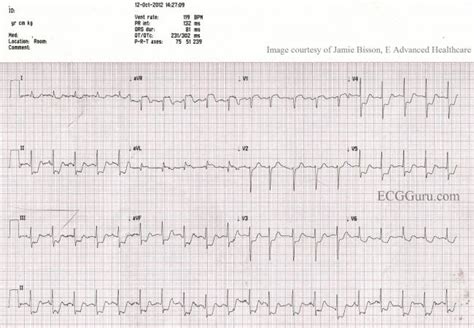 Left Main Coronary Artery Occlusion | ECG Guru - Instructor Resources