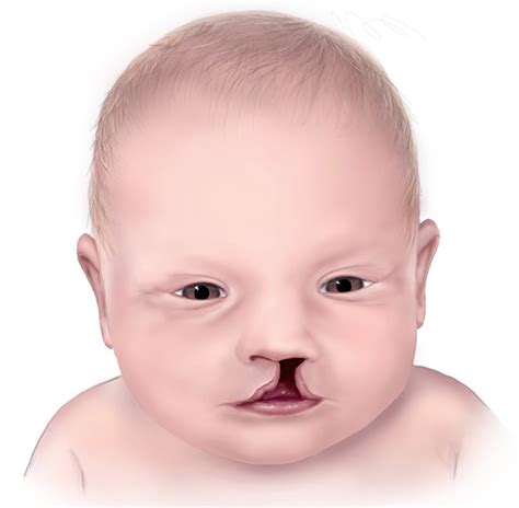 Cleft Palate & Cleft Lip - Causes, Symptoms, Repair, Surgery