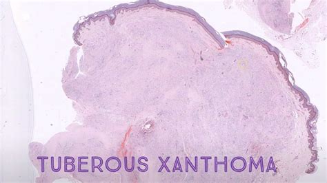 Tendinous Xanthoma Histology