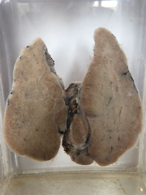 Hashimotos thyroiditis – gross – Histopathology.guru