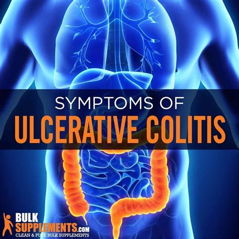 Tablo | Read 'Ulcerative Colitis: Symptoms, Causes & Treatment' by