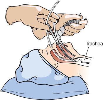 Anesthesia: techniques and agents | Basicmedical Key