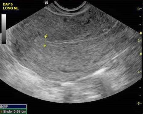 The endometrial lining is thin and early proliferative phase (note the ...