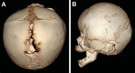 Craniosynostosis | UF Health, University of Florida Health