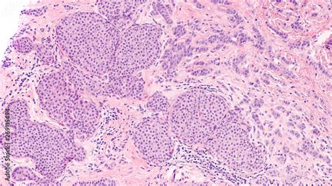 Invasive Ductal Carcinoma Histology