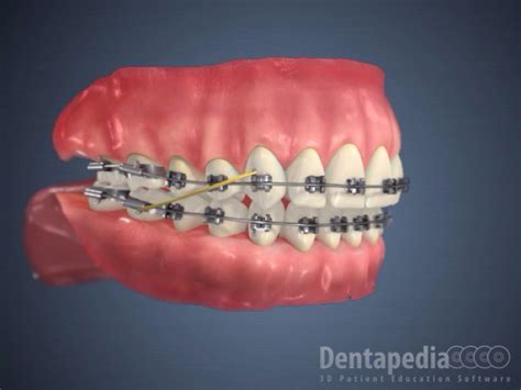 Maloclusion clase II molar y canina, los dientes no encajan, los ...