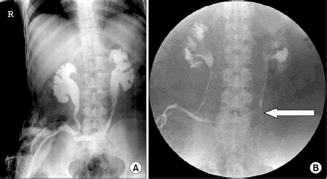 Ureterostomy Stent