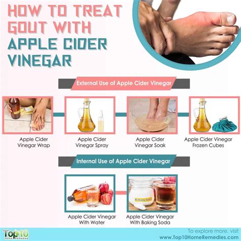 Does Apple Cider Vinegar Help Gout | Examples and Forms