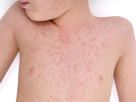 Rubella: 10 Rubella Symptoms