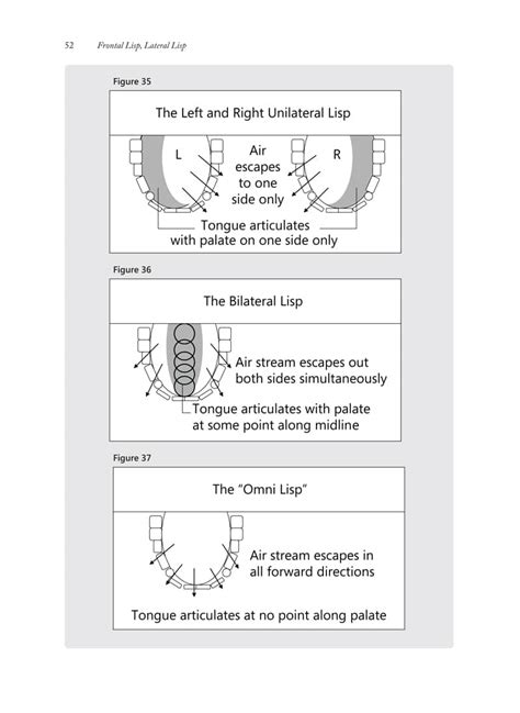 Frontal Lisp, Lateral Lisp - Speech Corner