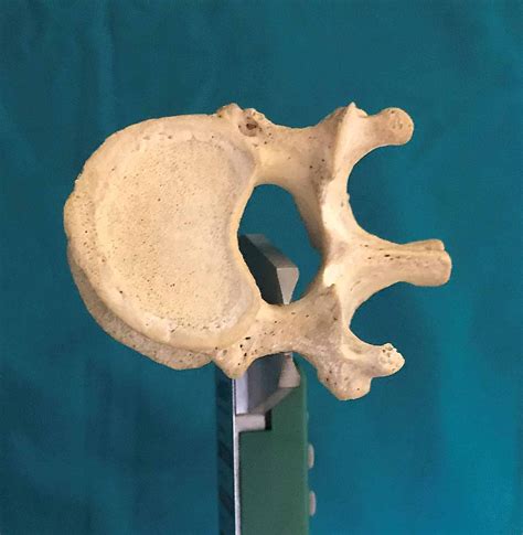 Thoracic Pedicle Morphometry of Dry Vertebral Columns in Relation to Trans-Pedicular Fixation: A ...