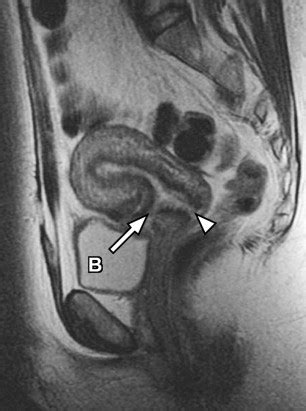 Normal Female Pelvic Mri