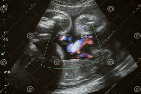 Ultrasound Photo of Unborn Baby in Mother`s Womb, Closeup View Stock Image - Image of pregnancy ...