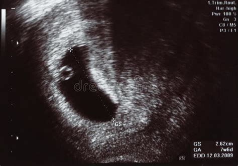 Ultrasound Scan One Month Stock Photos - Image: 5922863