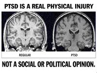 PTSD = Brain Injury