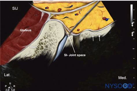 Sacroiliac Joint Injection Technique