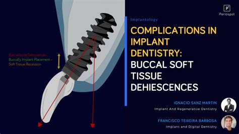 How Deep Is Your Implant? Supracrestal, Crestal, and Subcrestal Implant ...