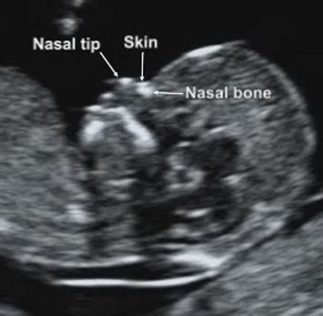 12 Week ultrasound – Maternal Fetal Medicine