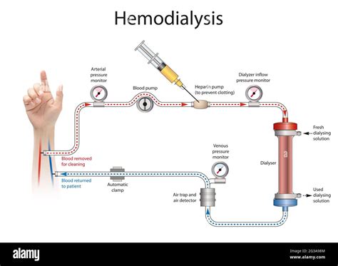 Hemodialysis procedure Cut Out Stock Images & Pictures - Alamy