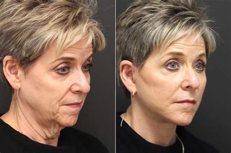 Facelift Photos | Princeton, NJ | Patient 10055