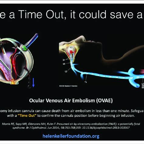 (PDF) Ocular Venous Air Embolism (OVAE): A Review