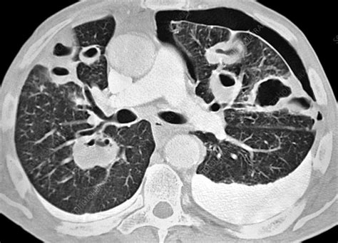 Bacterial pneumonia, CT scan - Stock Image - C034/5694 - Science Photo ...