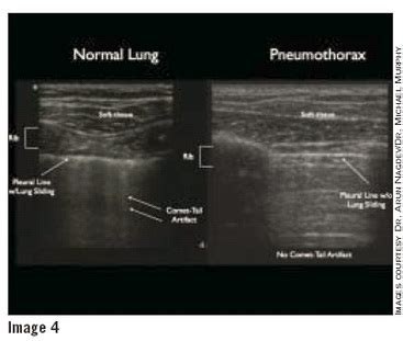 The Detection of Pneumothorax with Sonography - An Ultrasound technician