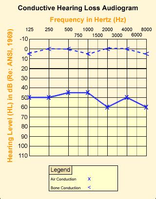 otitis media audiogram