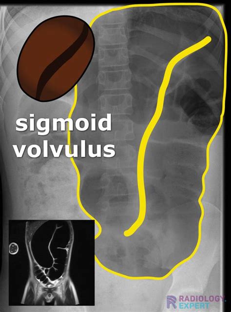 Sigmoid Volvulus Mri