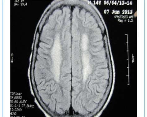 Hyperintensity in periventricular white matter on T2 weighted image in ...