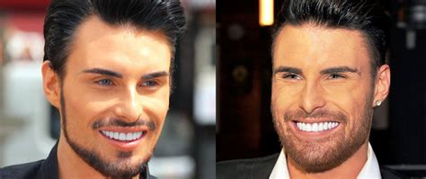 Rylan Clark New Teeth Before And After Photos