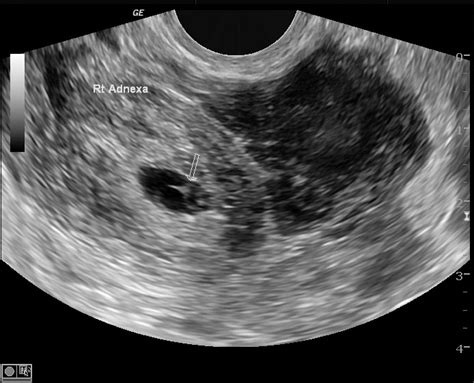 Tubal ectopic pregnancy | Image | Radiopaedia.org