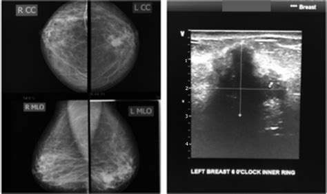 The LCC and LMLO views of the mammogram (left) show an oval dense,... | Download Scientific Diagram