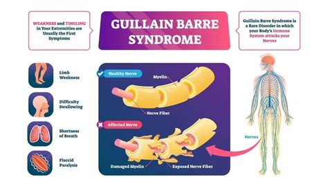 Healthcare Rehabilitation: Guillain Barre Syndrome | Guillain barre ...