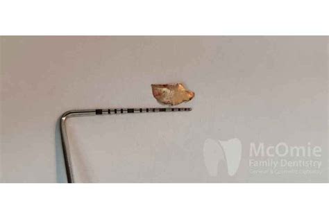 Dental Trauma Restorations Patient Before and Afters - McOmie Family Dentistry