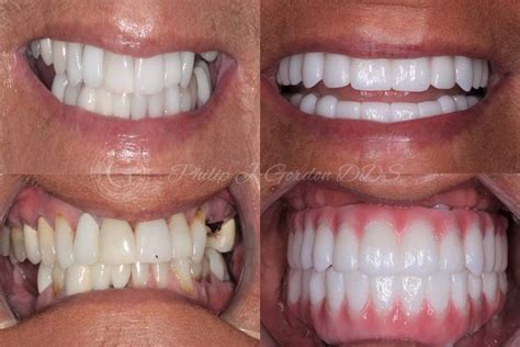 Dental Implants Before and After - Gordon Dental Implants & Cosmetics