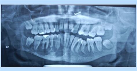 Rare Case of Traumatic bone cyst of the mandible in patient with Langer-Giedion syndrome ...