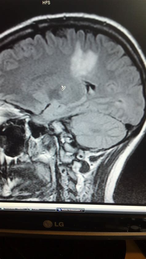 Tumefactive Multiple Sclerosis: MRI pics January