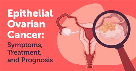 Diagnosis & Information | MyOvarianCancerTeam