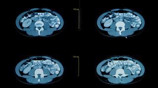 Side Effects of CT Scan with Contrast