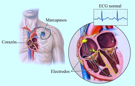 Bloqueo de rama, derecha, izquierda, corazón, causas, tratamiento y ...