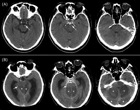 The catastrophic basilar artery occlusion | BMJ Case Reports