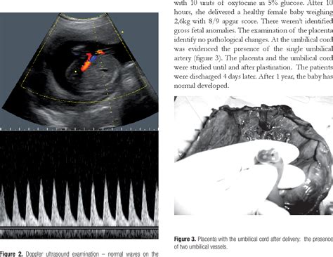 Figure 3 from Single Umbilical Artery | Semantic Scholar