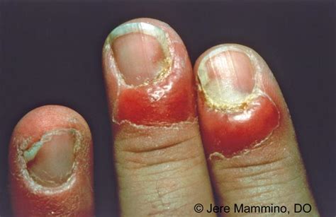 Staph Infection Fingernail